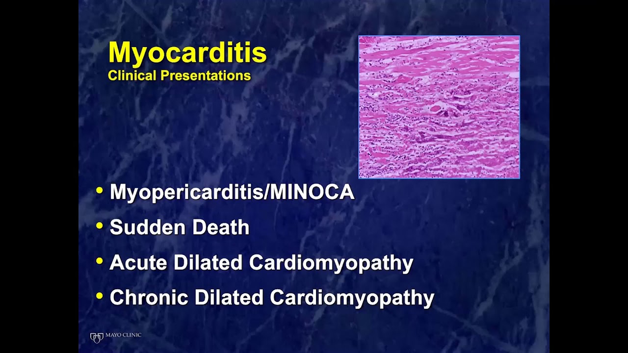 Presentation and Management of Myocarditis in 2021