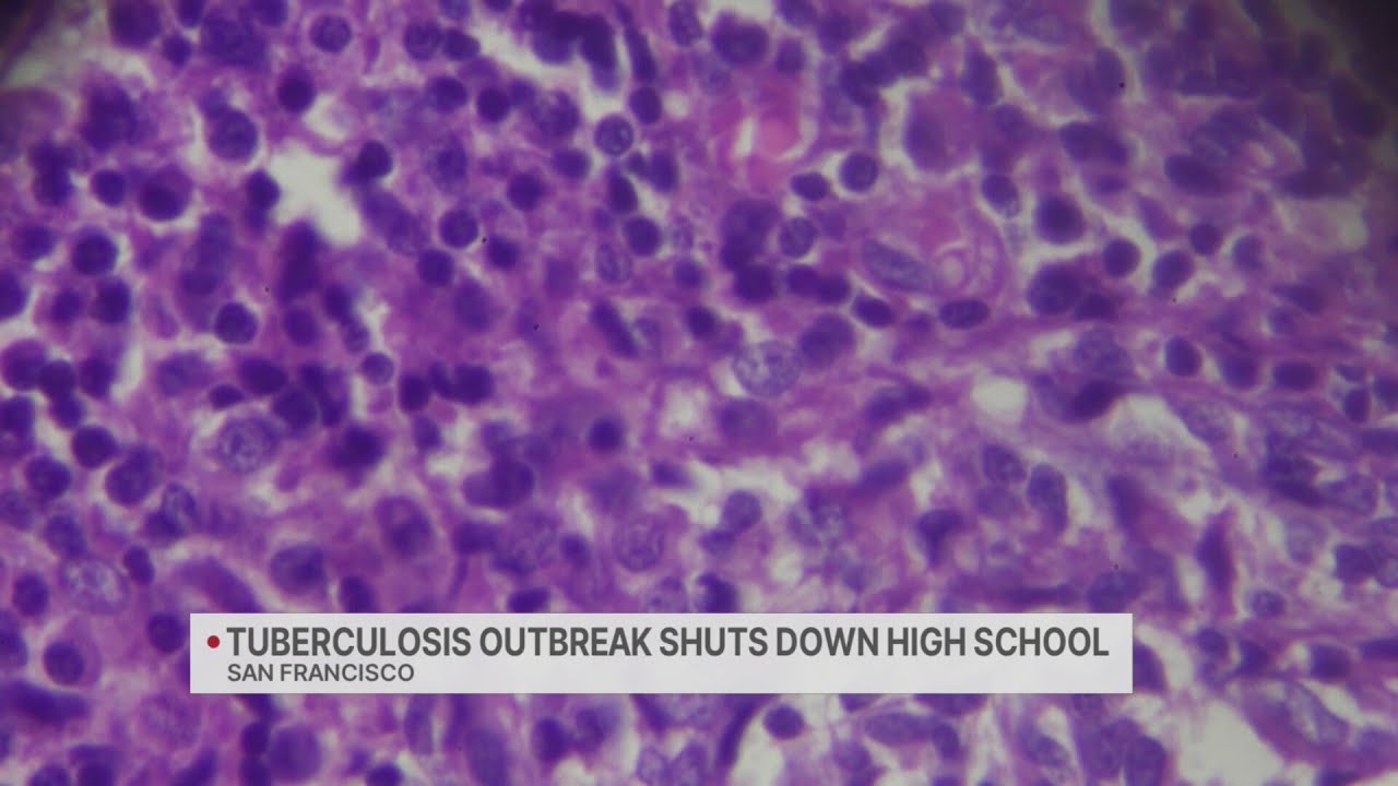 Catholic high school in SF cancels in-person classes due to tuberculosis outbreak