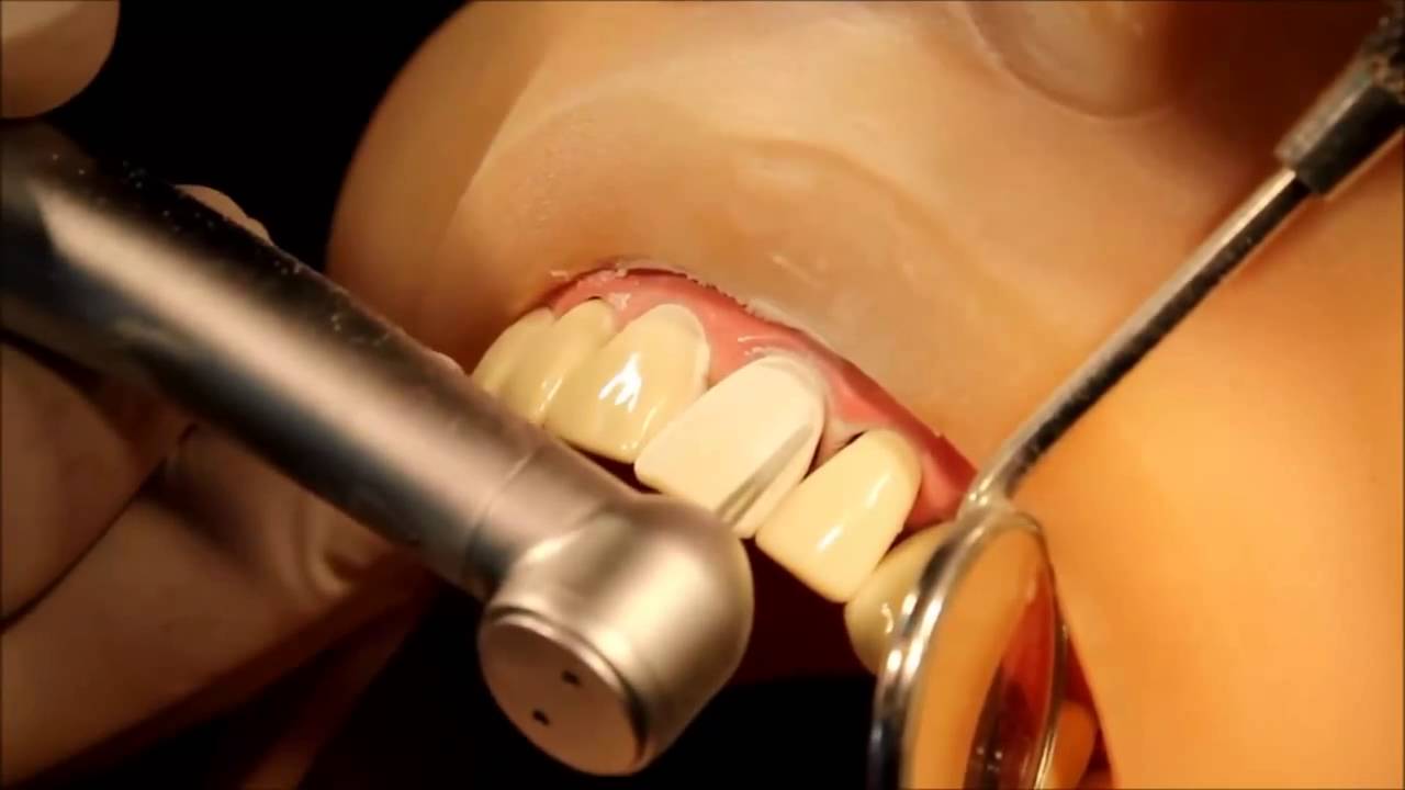 How To Make Laminate Veneer Preparation in 3 minutes