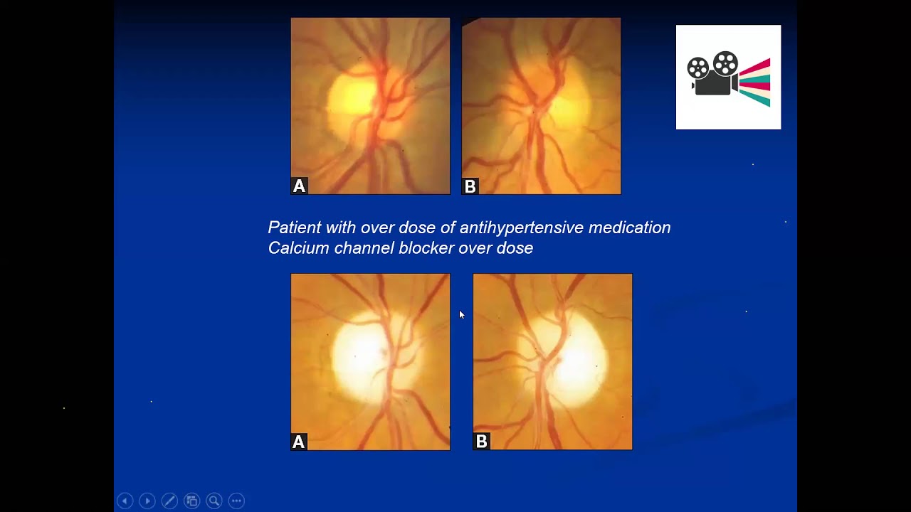 Ischemic Optic Neuropathy / Dr.Maha Badr.