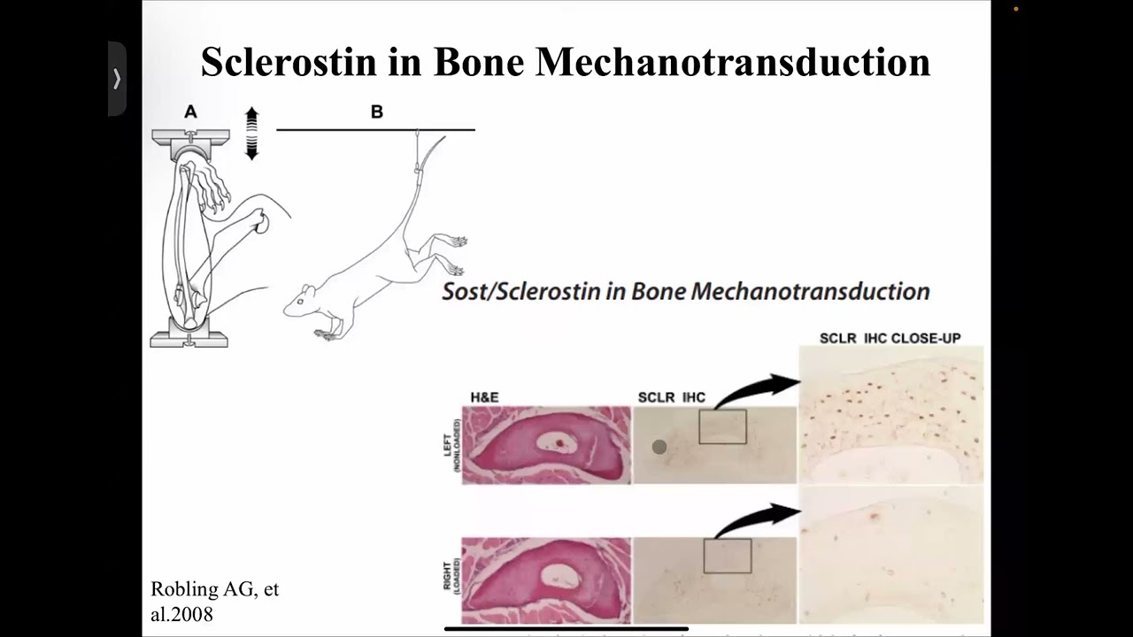 Bone health in spinal cord injury - Dr Gaurav Sanyasi