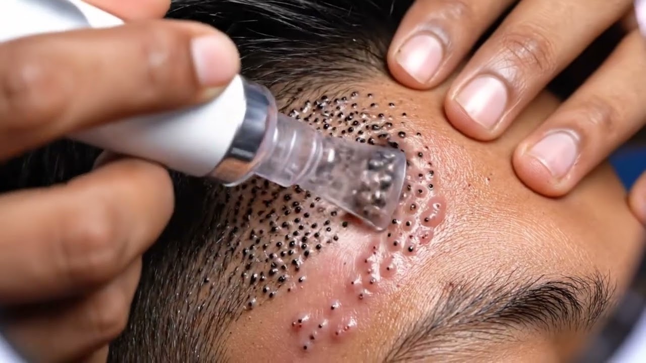 Most Satisfying Blackhead Vacuum Extraction Ever! Real Deep Pore Cleaning ASMR for Stress Relief,
