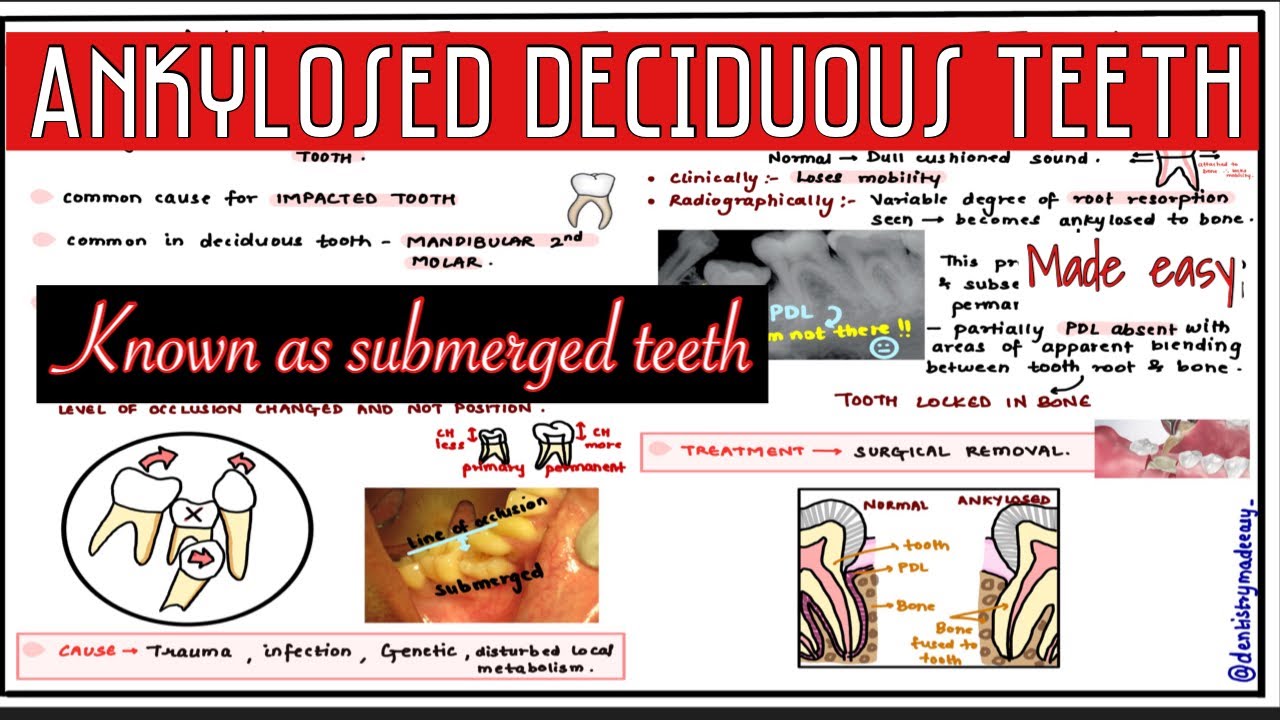 ANKYLOSED DECIDUOUS TEETH || SUBMERGED TEETH || Oral pathology