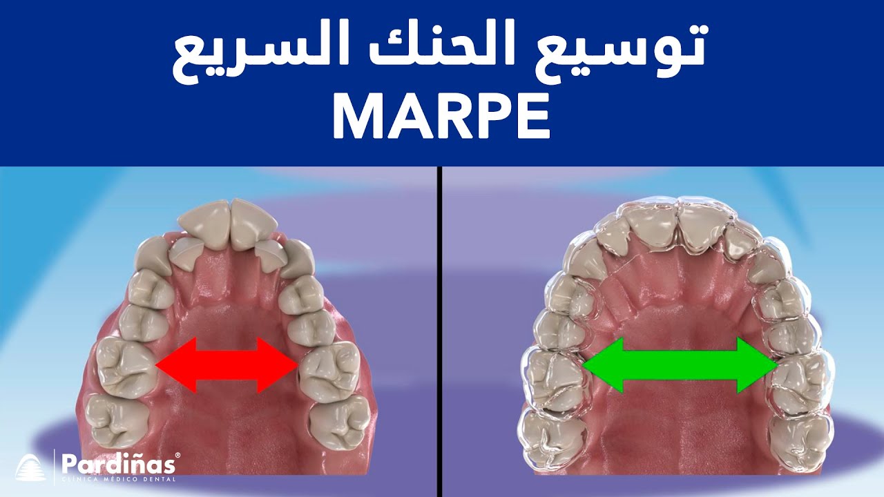 © (MARPE) توسيع الحنك السريع - موسع الحنك عند البالغين
