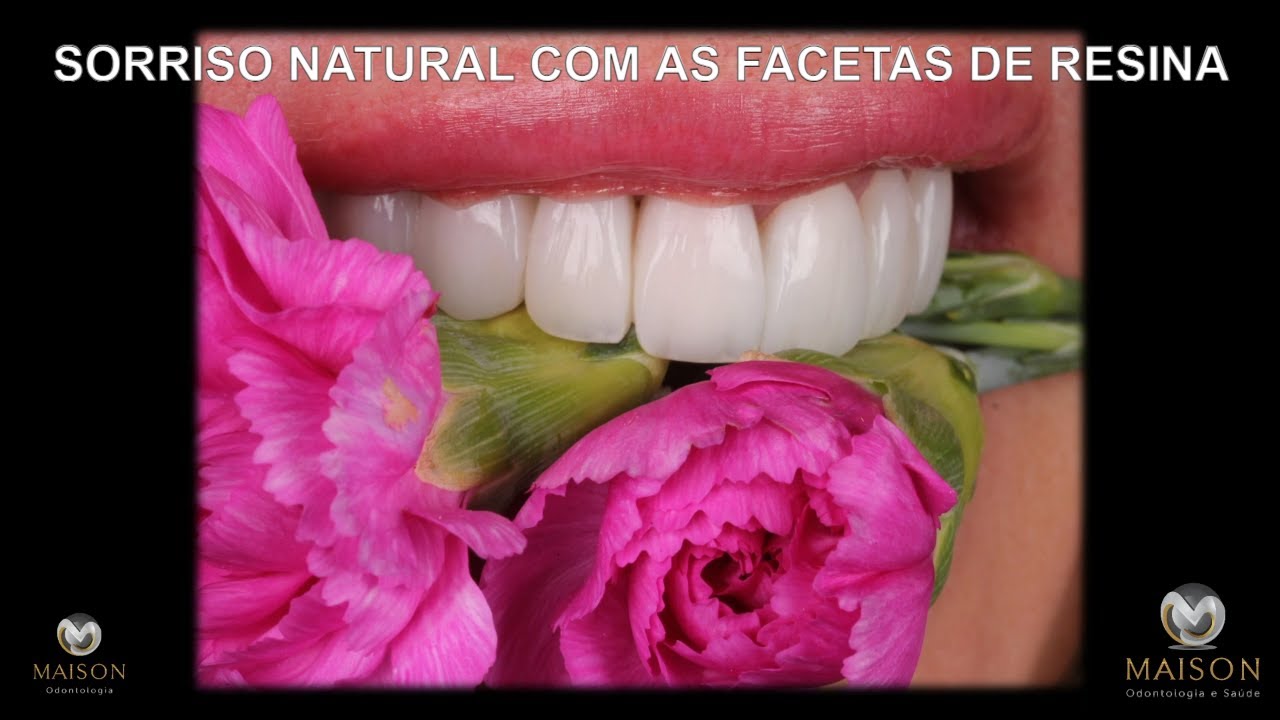 Transformando Vidas com Sorriso Perfeito | Facetas de Resina