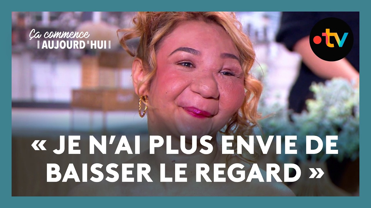 Particularité physique : comment réussir à s'aimer ? - Ça commence aujourd'hui