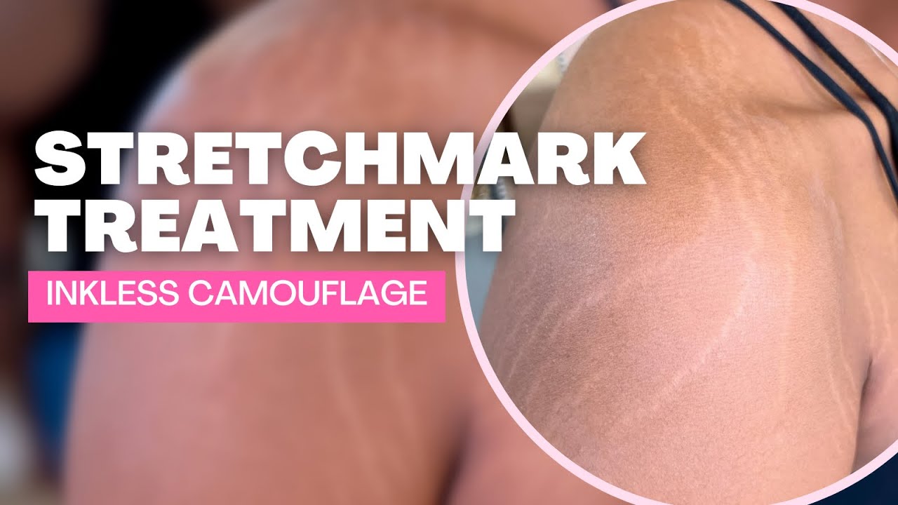Inkless Camouflage for Stretchmarks