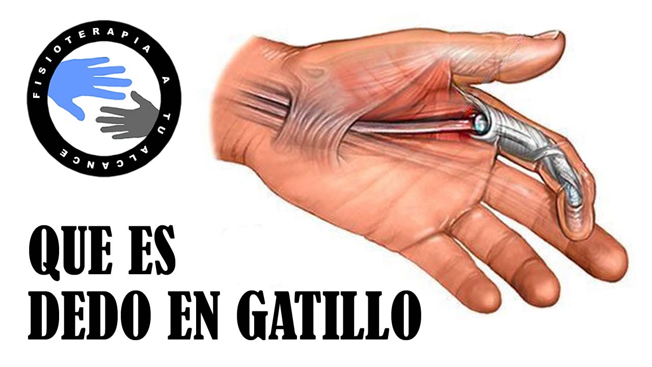 Dedo en gatillo o resorte, que es y porque se produce