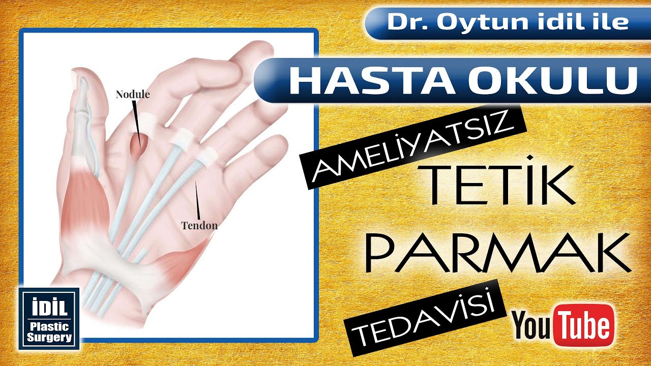 Ameliyatsız Tetik Parmak Tedavisi