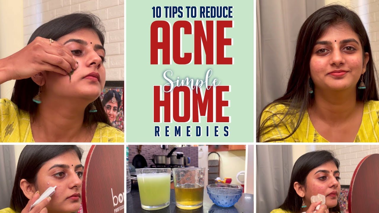Easy Ways To Reduce Acne | Simple Home Remedies | Gabriella Charlton