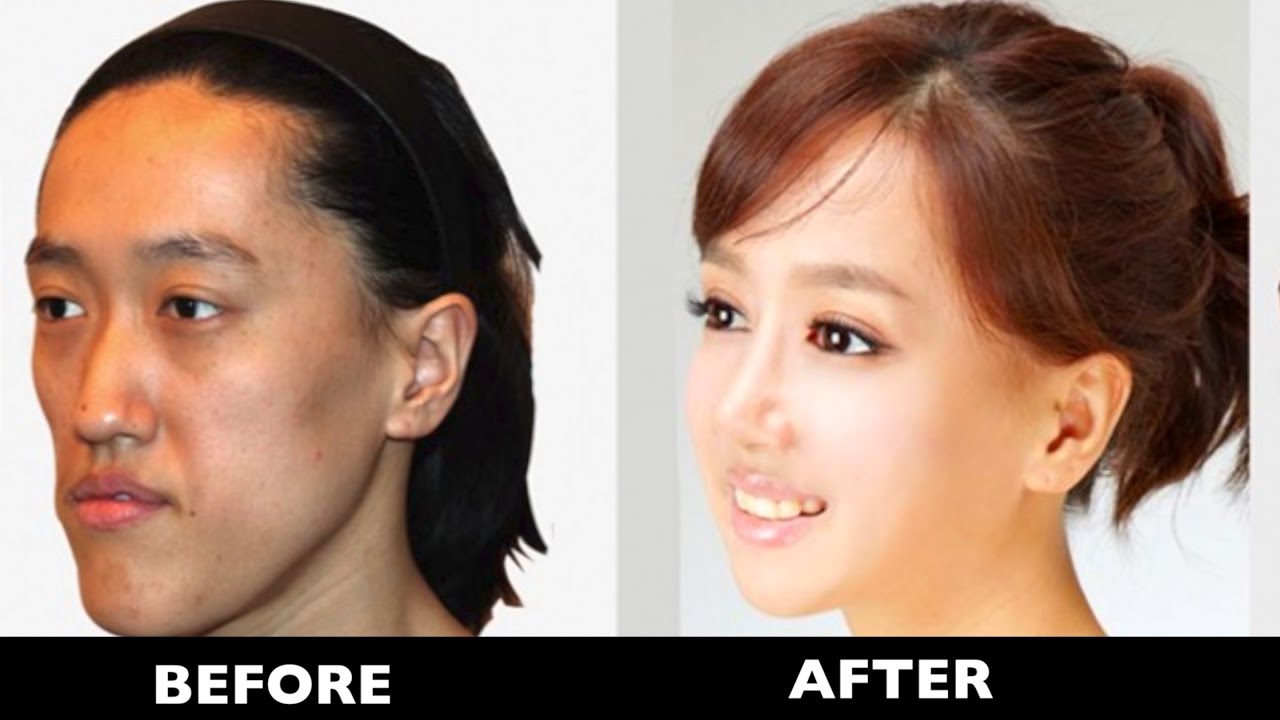 15 Korean Plastic Surgery Before & After Photos