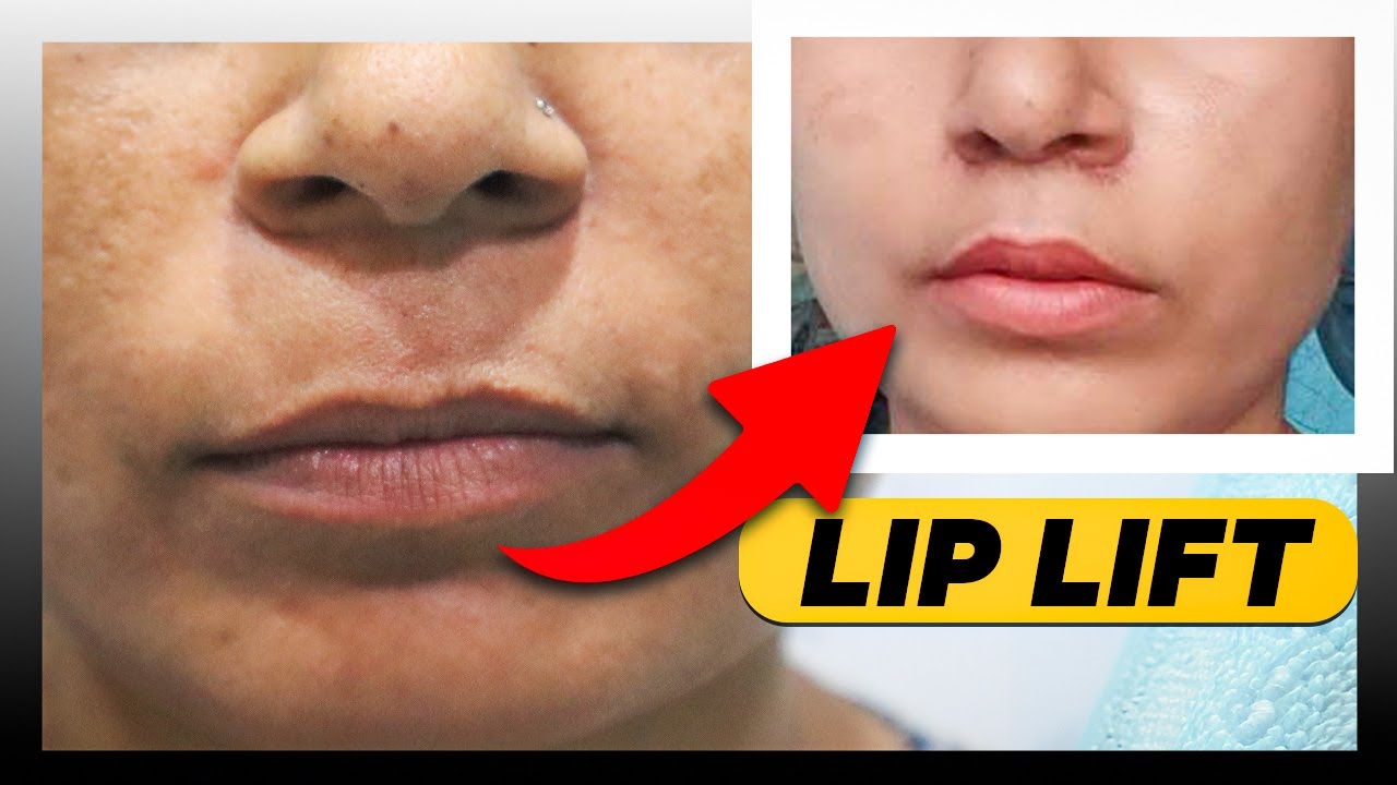 Best Lip Lift Surgery In Delhi - Lip Lift before after - (Patient Review)