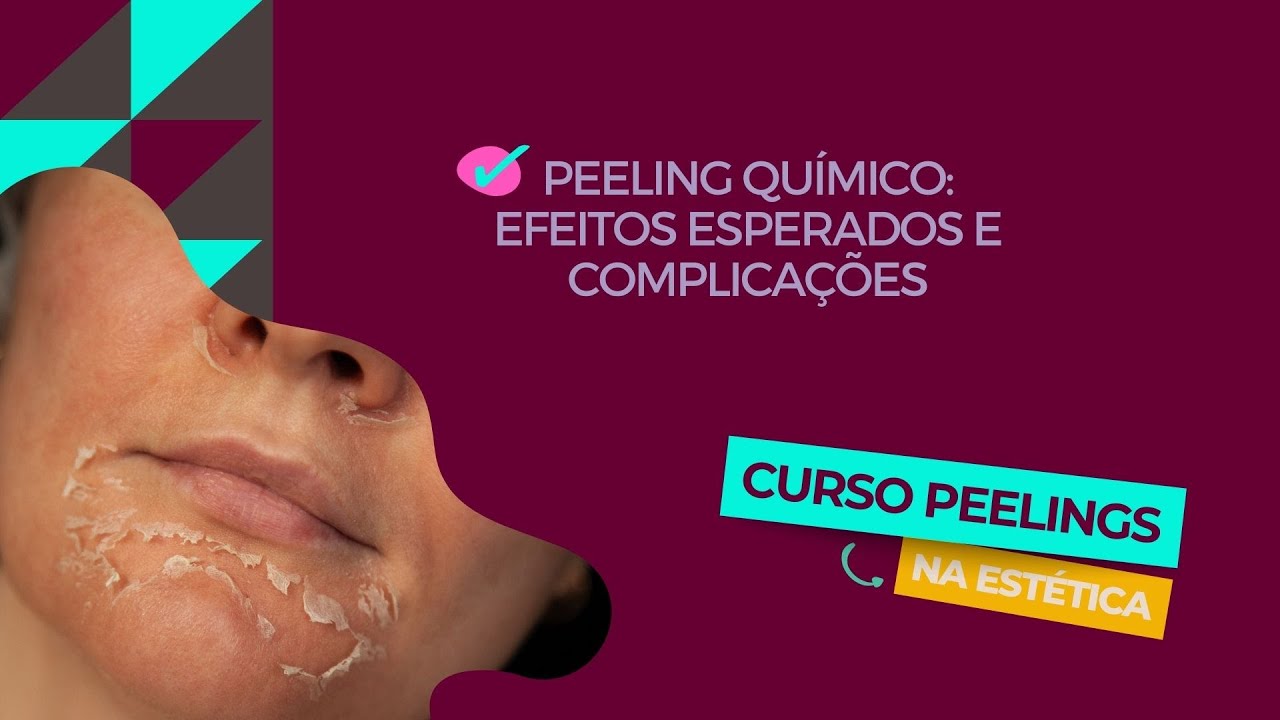 Peeling Químico: Efeitos esperados e complicações [Aula 22: Curso Peelings na Estética]