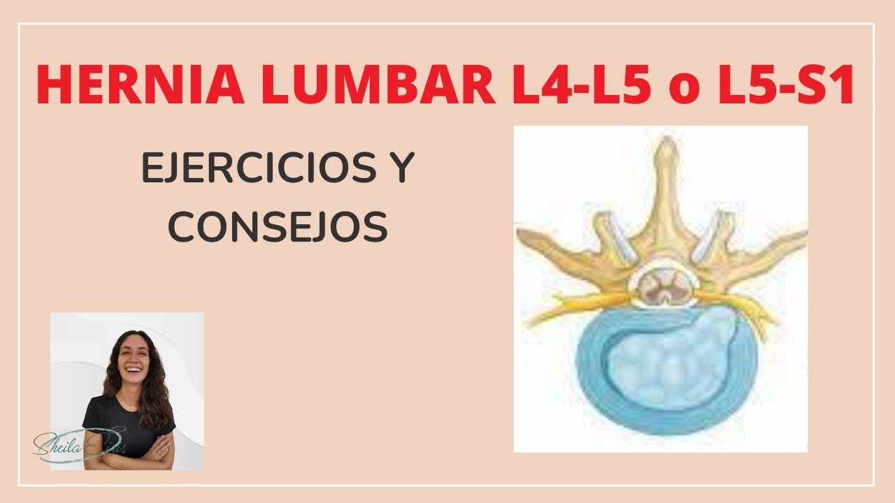 Hernia Lumbar: Cómo aliviar el dolor de manera definitiva