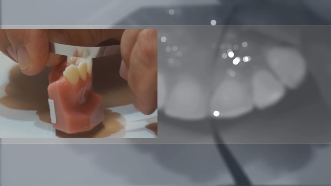 Easy Interproximal Access with FlexiSaw