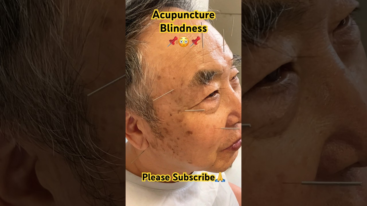 Acupuncture📌Blindness😳#viral #trending #shorts #acupuncturepoints