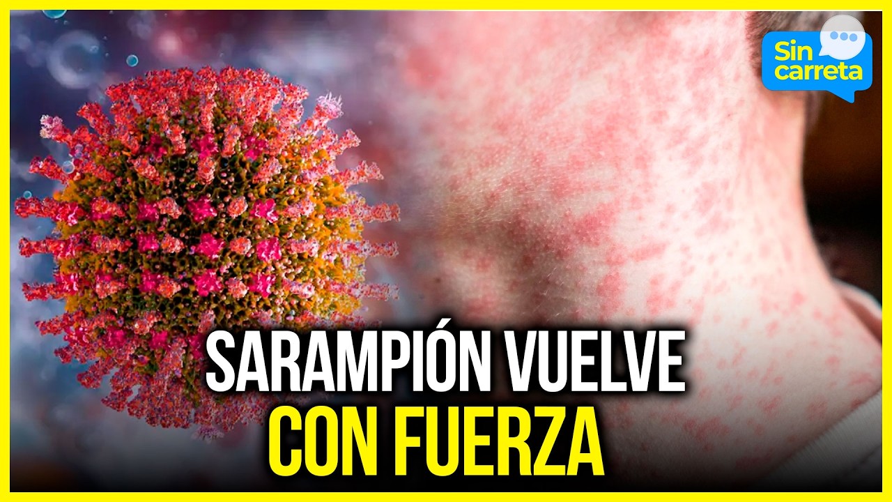 Sarampión en Colombia: ¿Peligro de epidemia? Tres casos confirmados en Bogotá | Noticias Sin Carreta