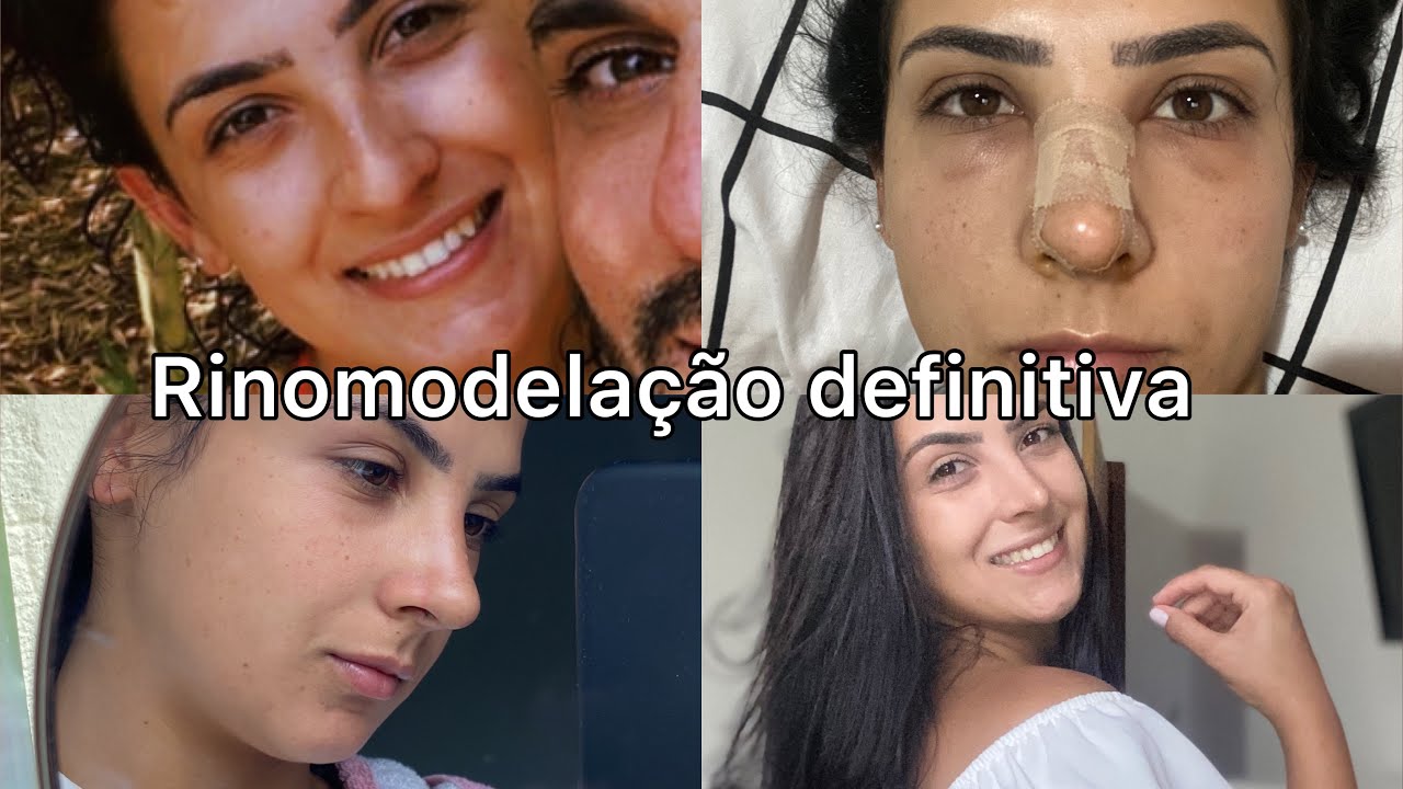 30 dias de Rinomodelação Definitiva