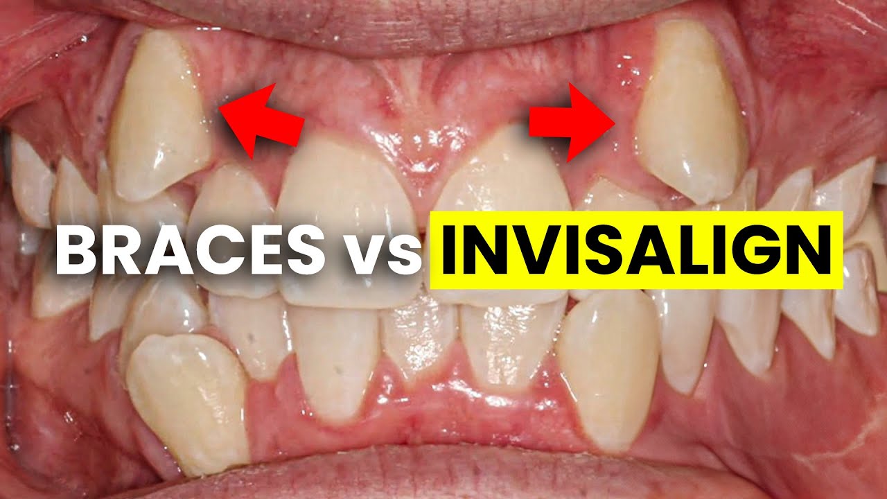 Braces vs Invisalign - Watch BEFORE Choosing a Treatment Plan