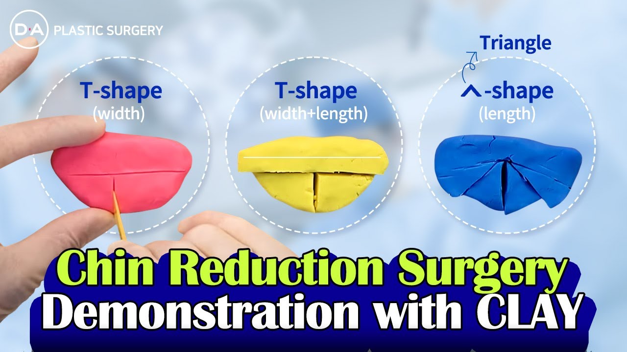 [Plastic Surgery Korea]Clay Demonstration? Different Types of Chin Reduction Face Contouring Surgery