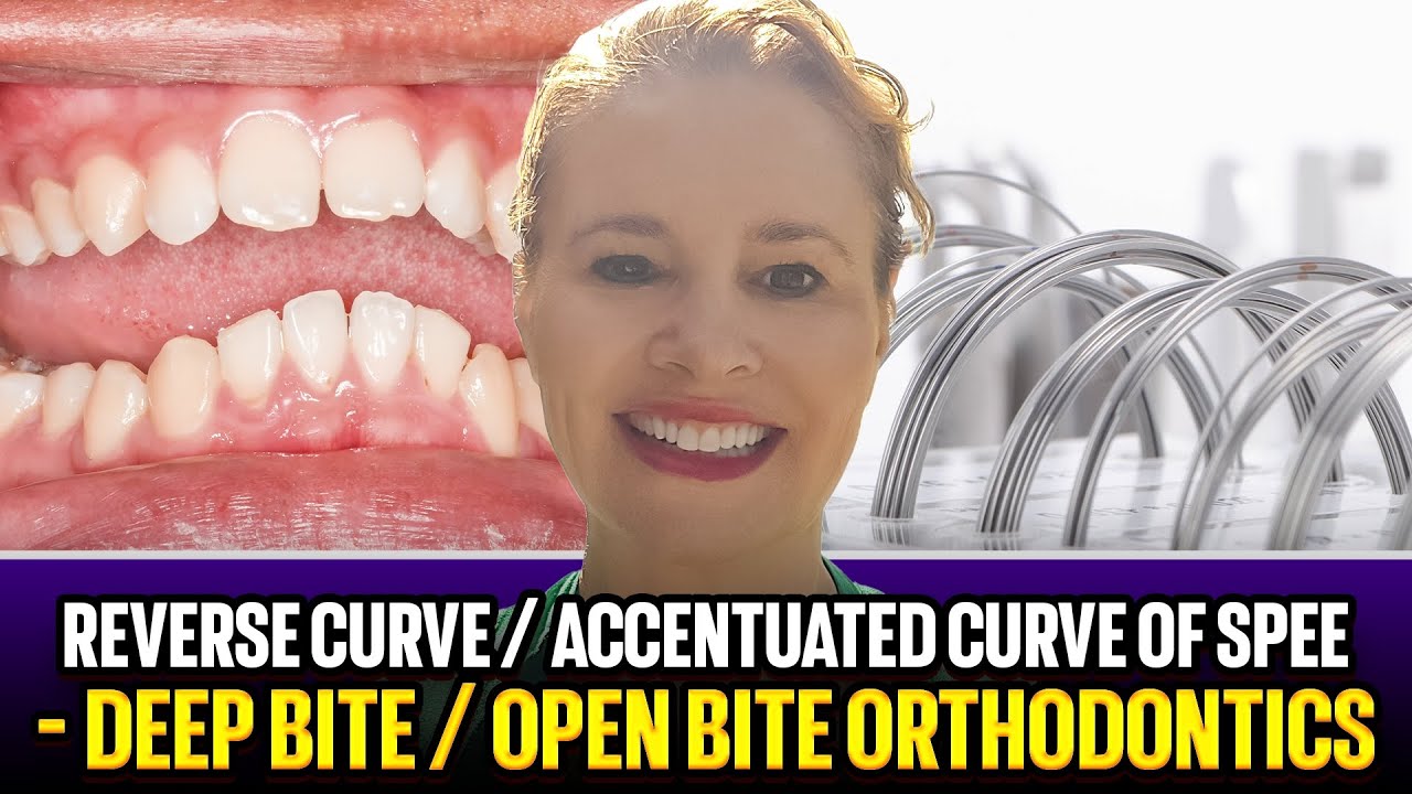 Reverse Curve/ Accentuated Curve/ RCS / ACS Wires Deep Bite Open Bite Orthodontics