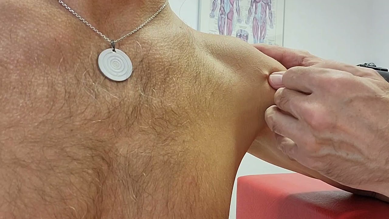 Dry Needling M. deltoideus p. clavicularis