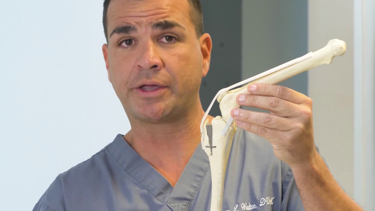 Modified Maquet Procedure (MMP) - Surgical Repair of CCL Tear in Dogs