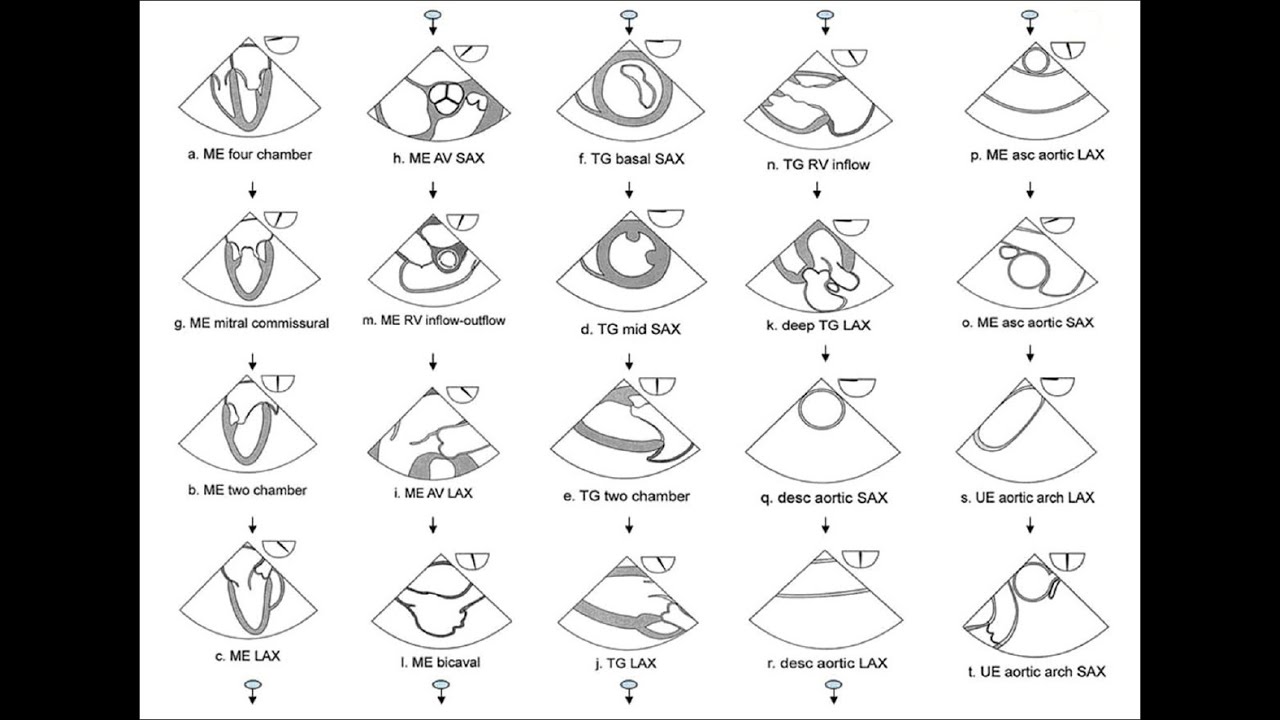 Comprehensive Transesophageal Echocardiograhic (TEE) Examination