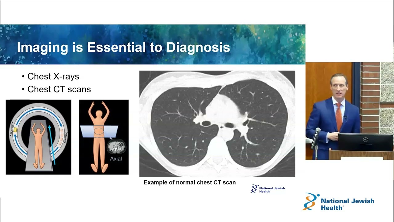 Overview of Bronchiectasis