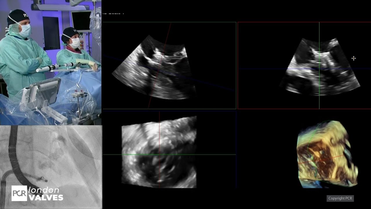 Advancing structural heart with 3D ICE and device guidance - PCR London Valves 2025