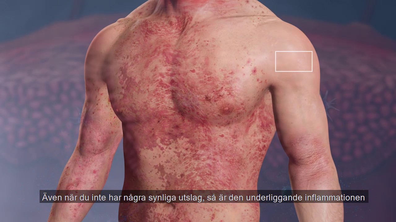 Vad är Atopisk Dermatit?