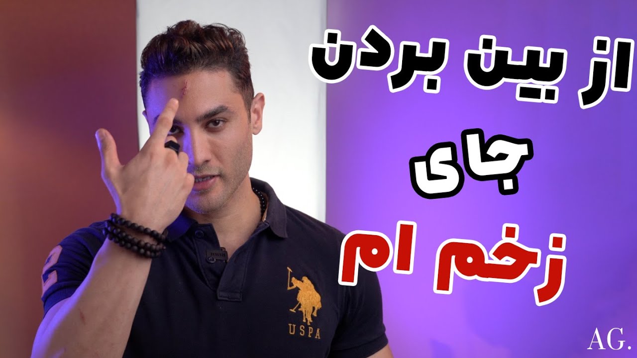۲۰۱ - روش درمانی من برای از بین بردن جای زخم و بخیه هام روی پیشانی