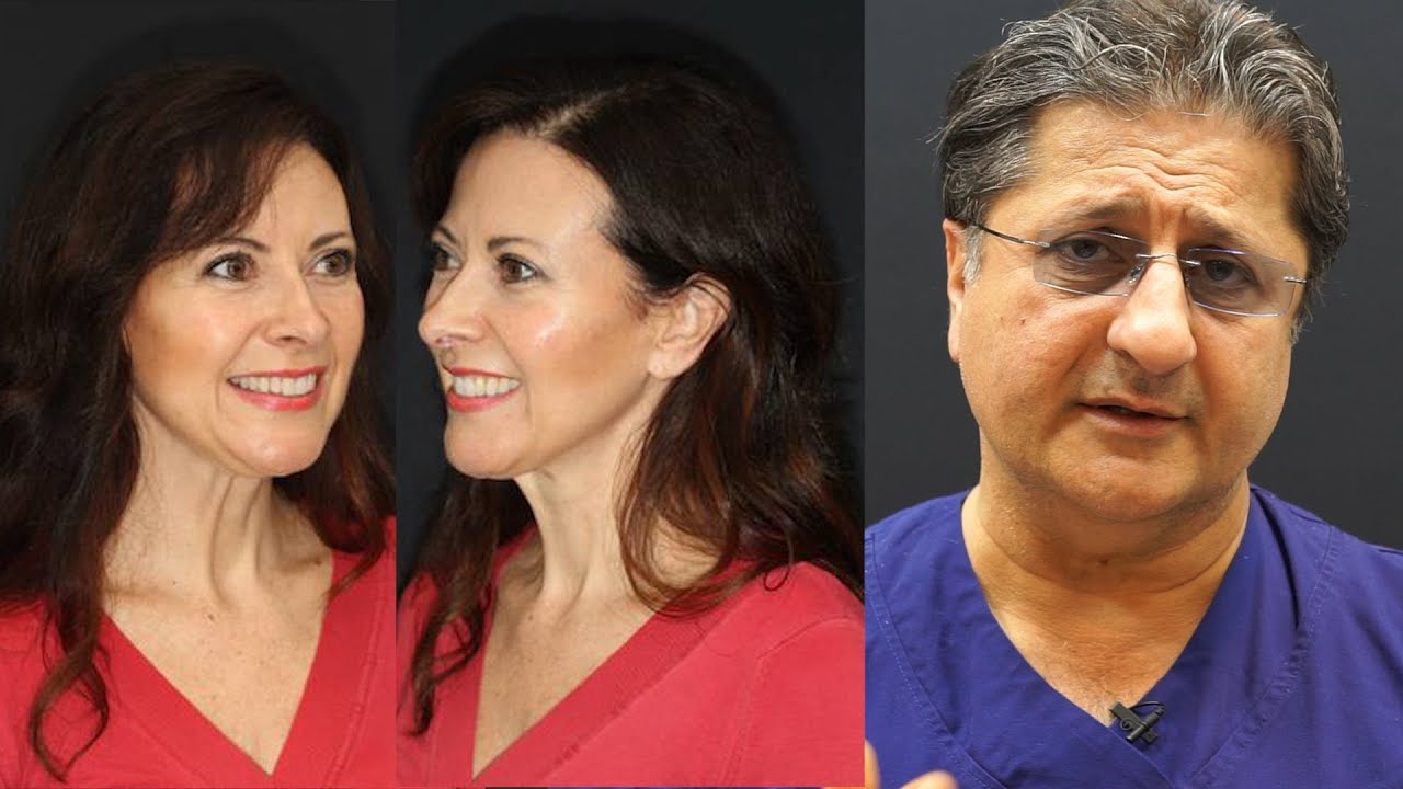 Composite Dental Veneers Smile Lift (10 Years Later)