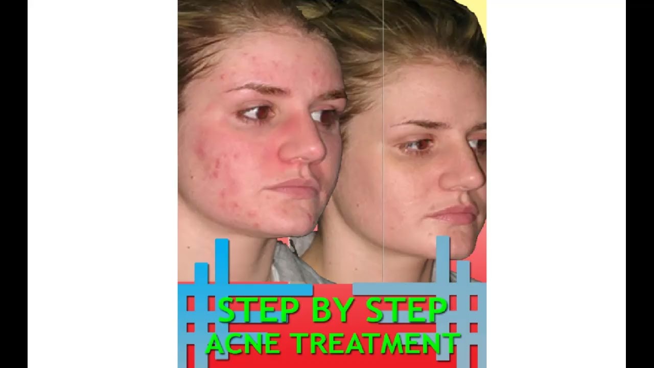 Step By Step Acne Treatment