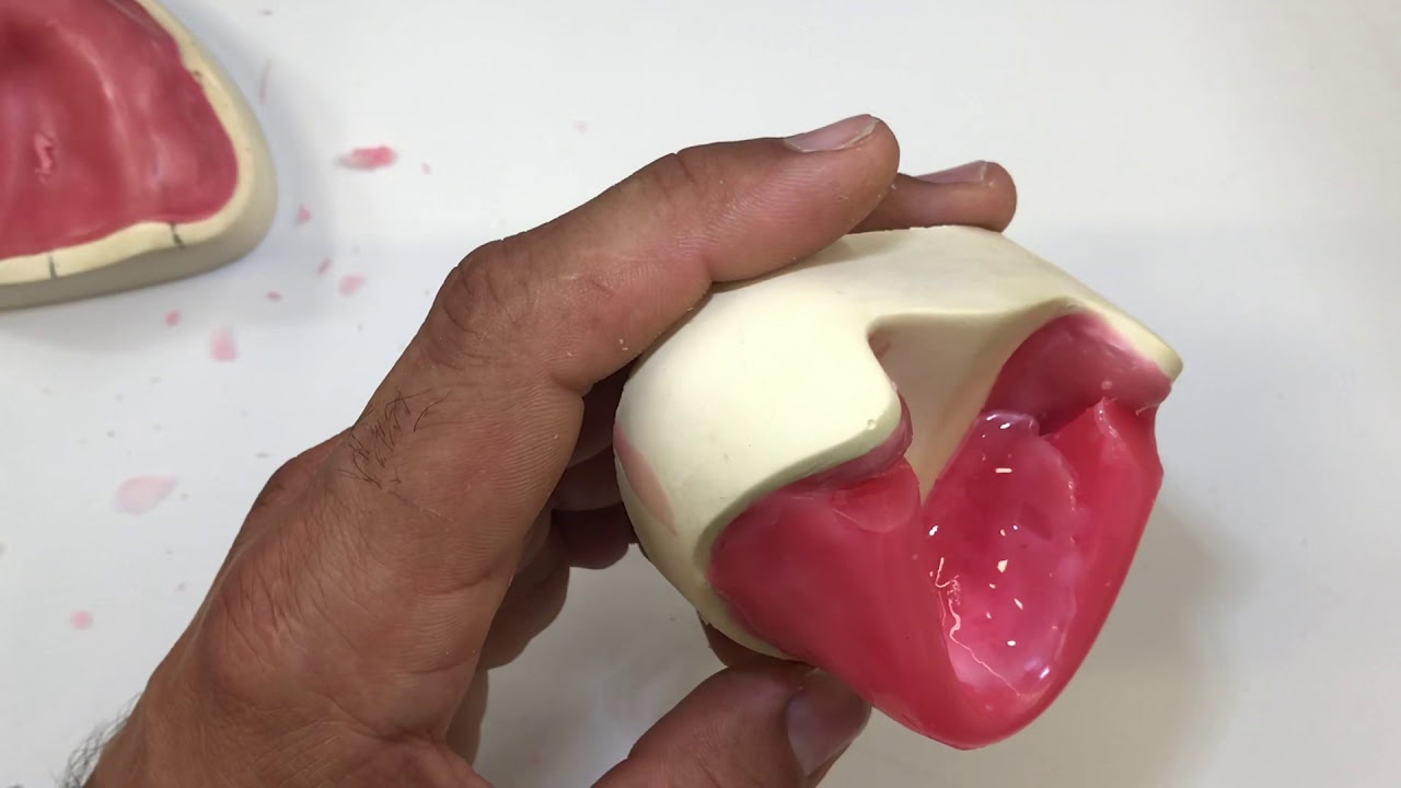 7d) Adapting Maxillary & Mandibular Occlusion Rims