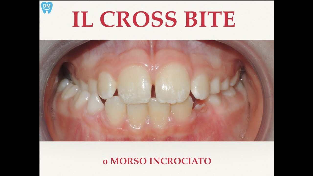 Cross bite o Morso incrociato - Domande e risposte! Studio Ortodontico Di Gioia & Martinetti