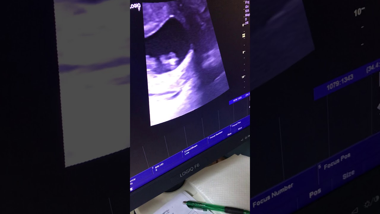 Kehamilan pertama USG hamil 9 minggu 3 hari di lambaikan tangan sama dede 🥰