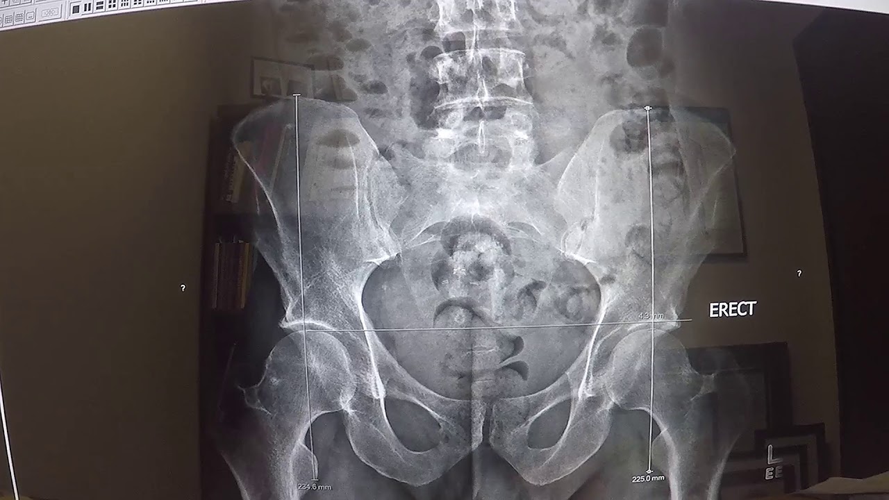 Gonstead x ray analysis of pelvis: Does this person need a shoe lift?