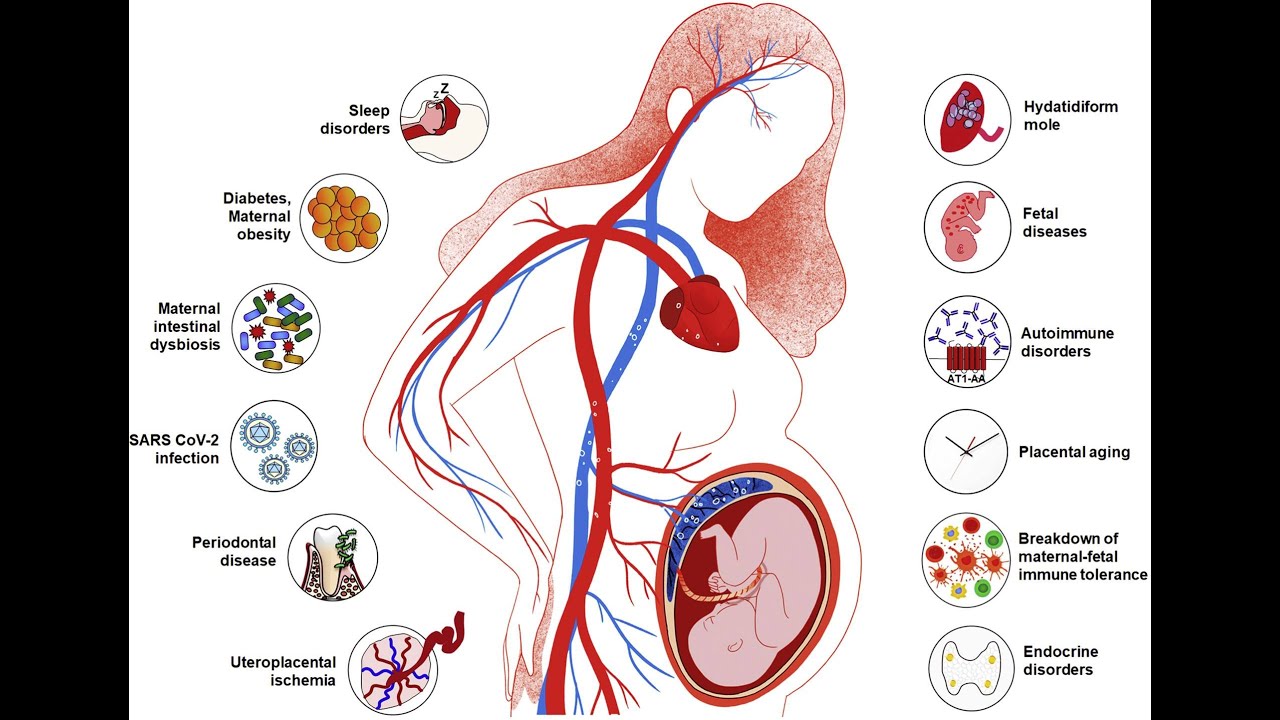 The Etiology of Preeclampsia