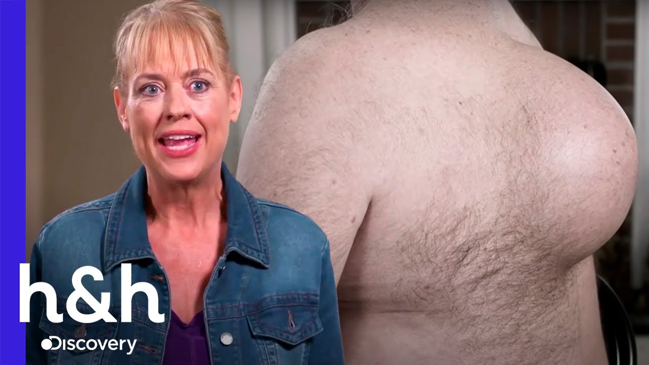Dos enormes bultos en la espalda  | Dra. Sandra Lee: Especialista en piel | Discovery H&H