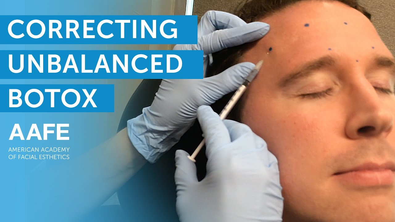 Correcting Unbalanced Botox at His Follow Up Appointment | AAFE