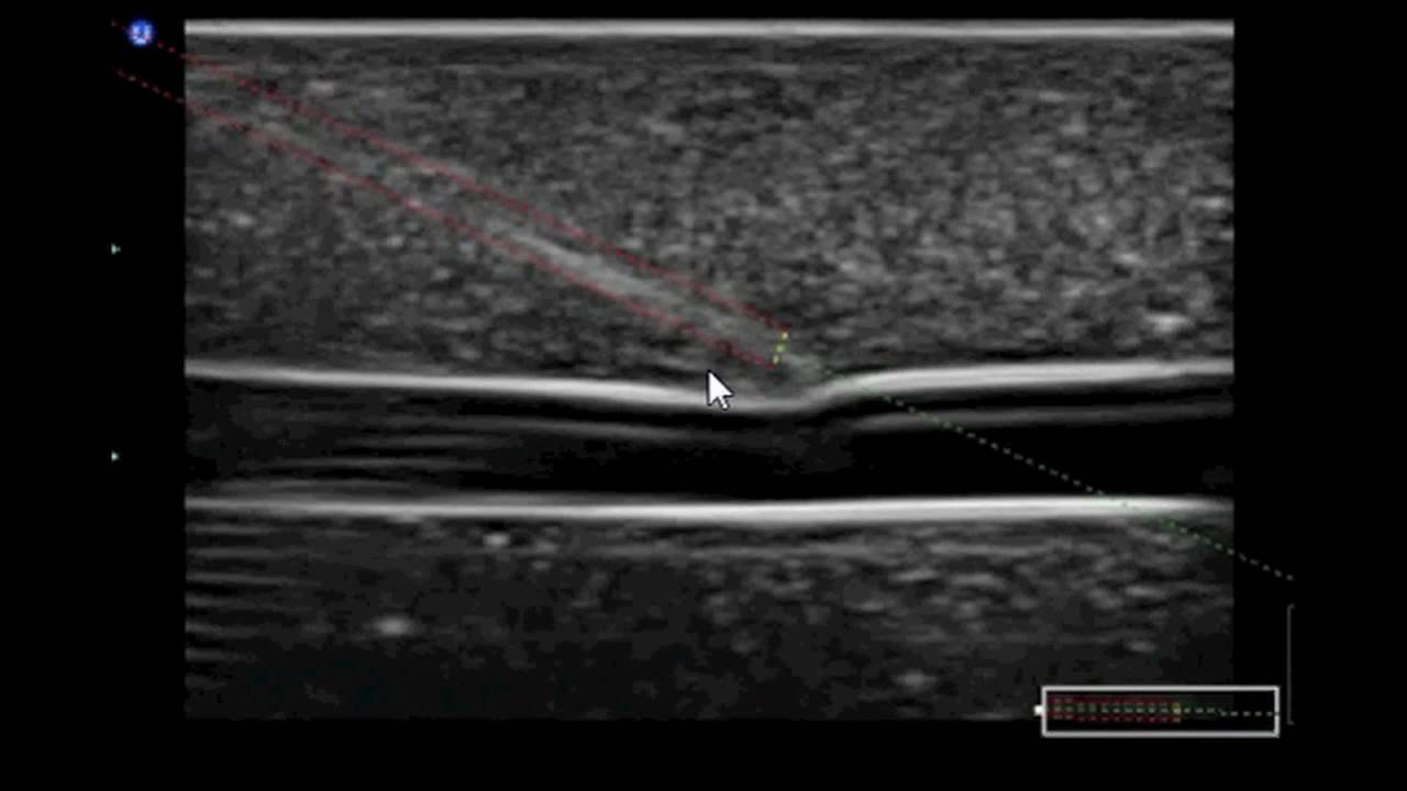 Enhanced Needle Visualization