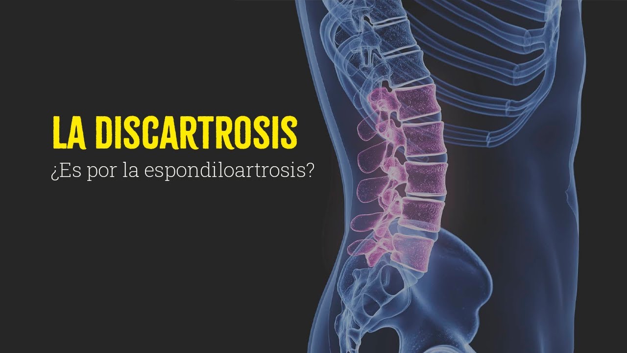 La discartrosis &iquest;Es por espondiloartrosis?