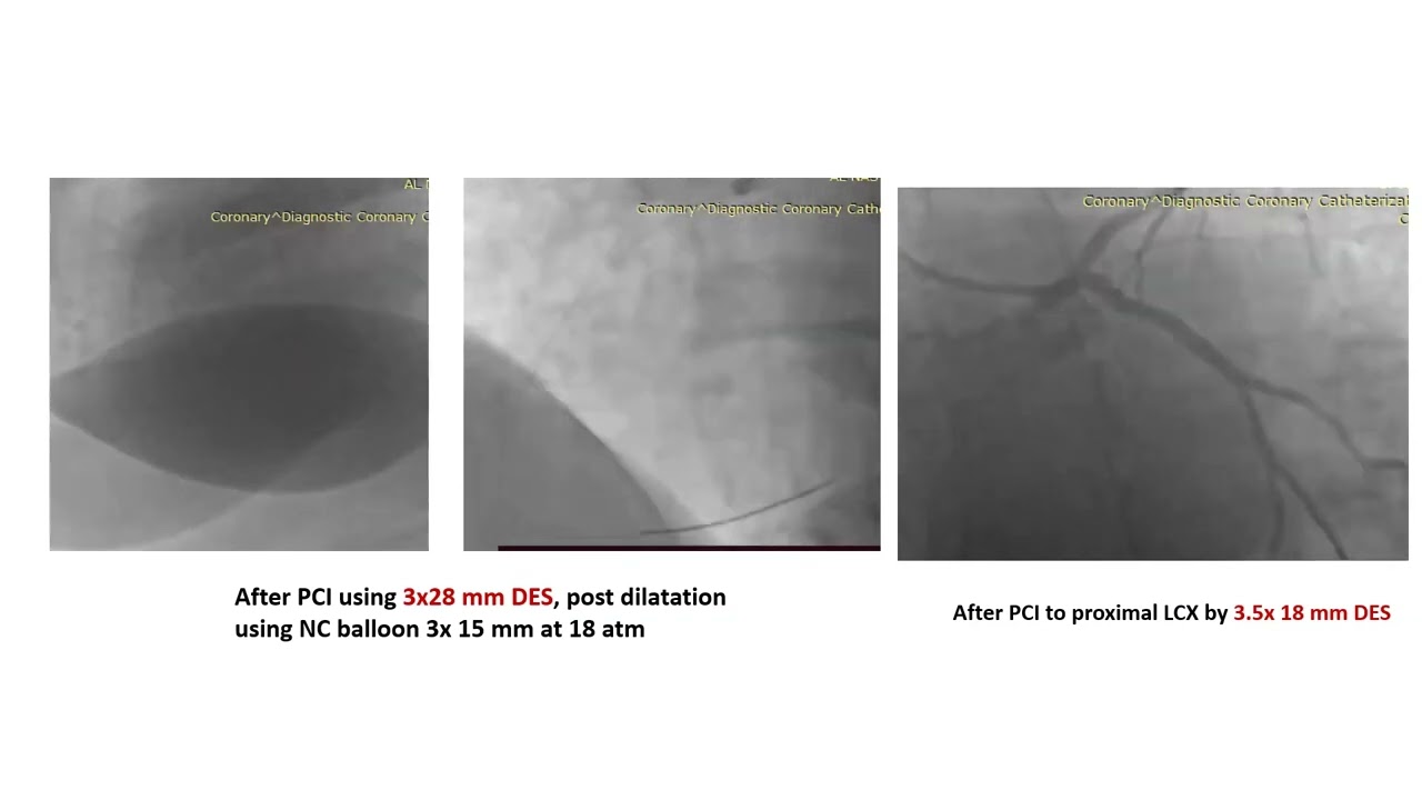 Cath Lab Seminar -Management of stent failure- Dr. Amir Anwar
