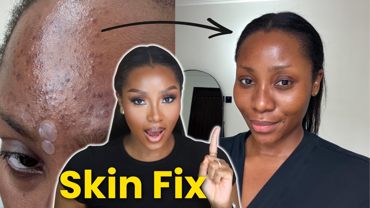 HOW I GOT CLEAR, EVEN SKIN | 5 Skincare Rules for Acne-Prone Dark Skin