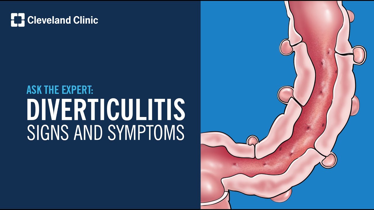 Warning Signs of Diverticulitis | Ask Cleveland Clinic's Expert