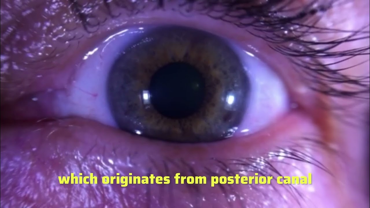 How to Identify Torsional Nystagmus in Posterior Canal BPPV