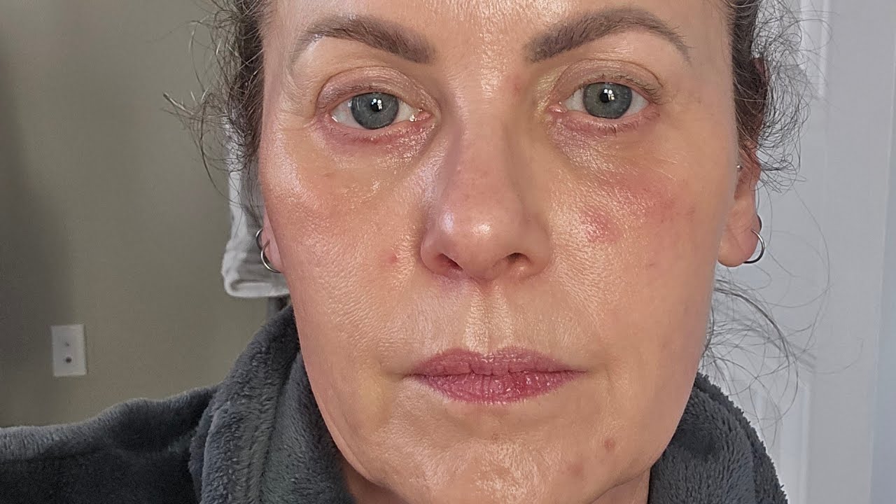 Eczema and Prednisone 