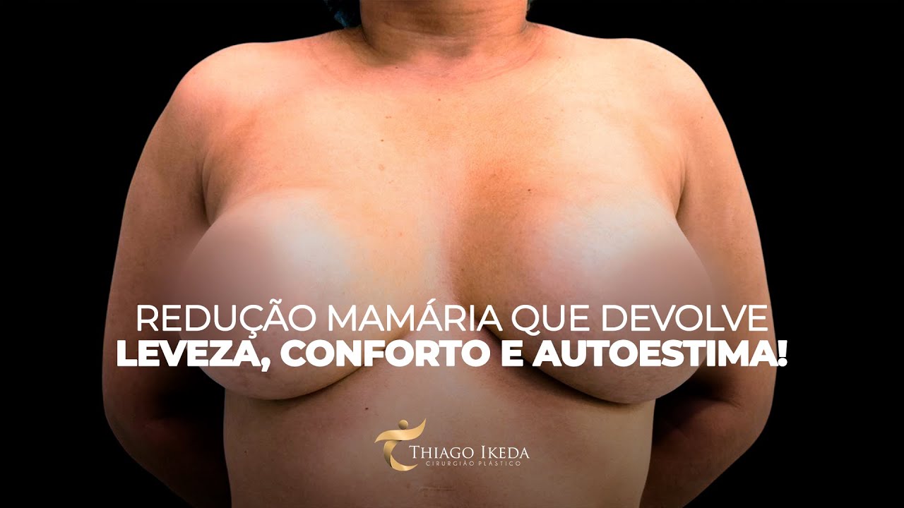 REDUÇÃO MAMÁRIA | CIRURGIA PLÁSTICA COM DR. THIAGO IKEDA | LEVEZA, CONFORTO E AUTOESTIMA