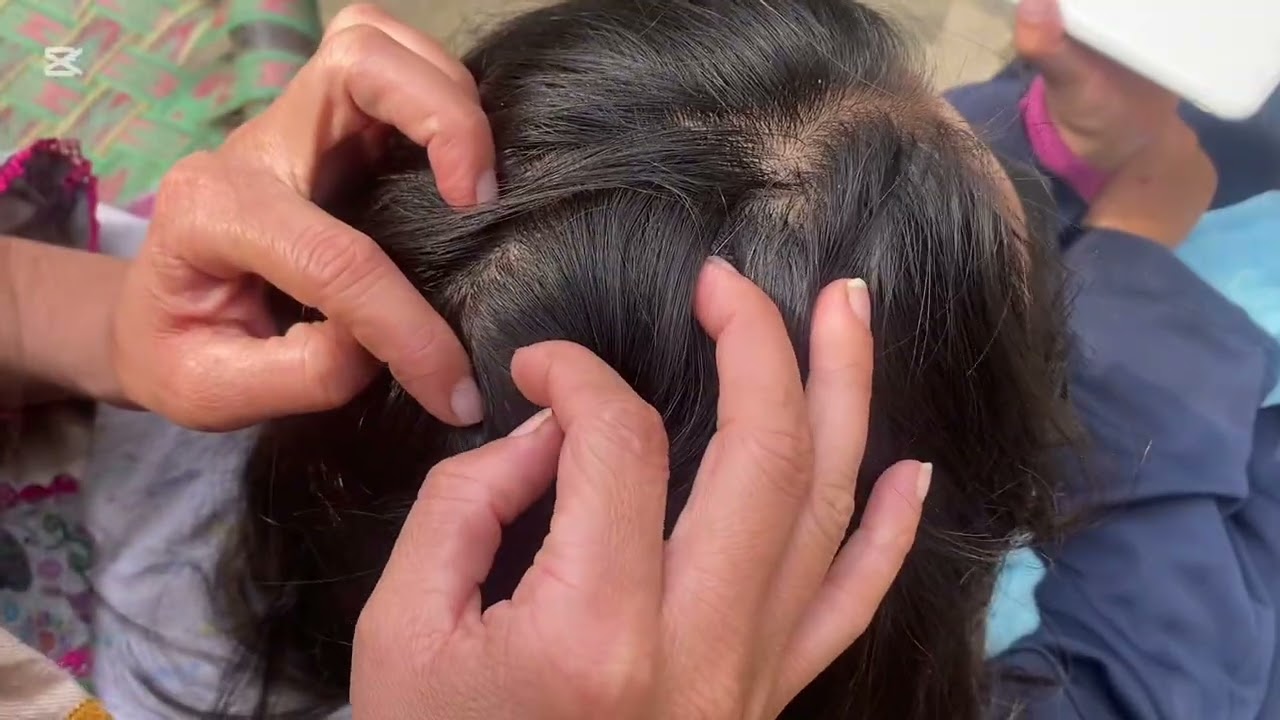| @LaibaButt-b8t | #nitspicking #licepicking #headlice #like #share #pleasesubscribe #plzsupport |